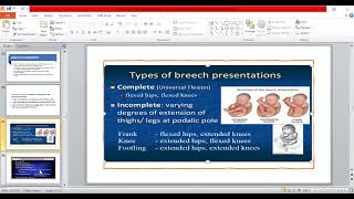 7B Malpositions amp Malpresentation part2  OBG [upl. by Sacttler]