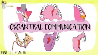 Oroantral Communication AND Fistula  Treatment options  Oral Surgery [upl. by Kelwin47]