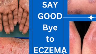 Management guidelines of eczema skin specialist advice How to treat eczemaskinhealthvitality5959 [upl. by Siberson]