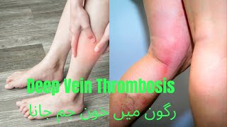 Deep vein thrombosis رگون میں خون جم جانا [upl. by Mair]