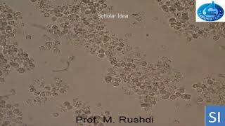 Pyuria Pus cells in urine2 [upl. by Aronas628]