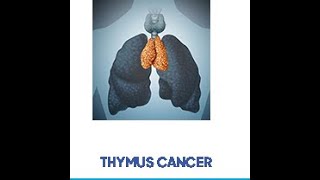 thymoma with pleural mets [upl. by Amitak]