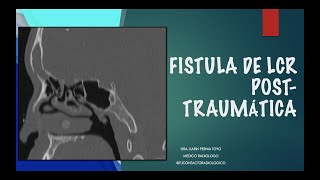 FISTULA LCR DRA KARIN PERNIA TOYO [upl. by Colwen]