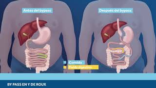 Bypass en y de roux  tratamiento de la obesidad [upl. by Irej688]