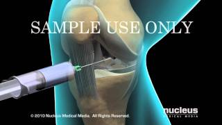 Knee Arthroscopy [upl. by Linden238]