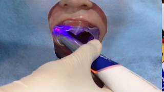 Caries Detection QLf technology [upl. by Natalina995]