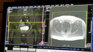 School of Medical Imaging MRI Lab  Hip [upl. by Tennek]