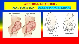 ABNORMAL LABOUR  MAL POSITION  OCCIPITO POSTERIOR  OBG [upl. by Adolpho728]