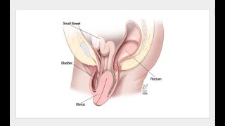 Pelvic Organ Prolapse uterus pelvicfloor pelvicinflammatorydisease pelvicfloorpt pelvichealth [upl. by Kylynn57]