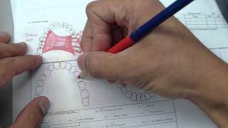 Removable Partial Denture  Reviewing design and how to draw [upl. by Friederike]