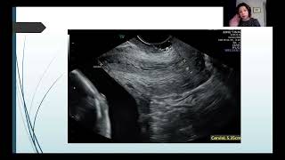 Endovaginal Imaging in MidPregnancy  Lisa Burechailo  Advanced Fetal Imaging Conference [upl. by Fillbert258]