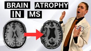 Brain Atrophy in Multiple Sclerosis Explained by Neurologist [upl. by Symer]