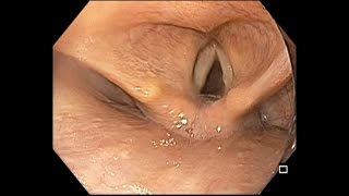 EGD  Step 1  Hypopharynx screening [upl. by Odoric]