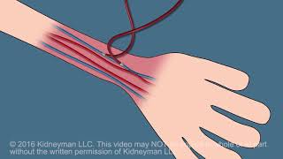 Dialysis Fistula animation [upl. by Hulburt]