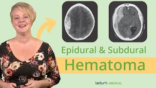 Key CT Findings in Epidural Hematoma 🩻  Trauma Emergency Medicine [upl. by Zebada]