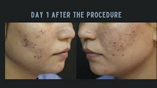 CO2 Laser Treatment for Acne Scars in 2 minutes  CO2 Laser Treatment Day 1 to Day 5 Before After [upl. by Darnall]