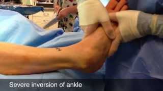 Surgery for Sprained Ankle [upl. by Codd733]