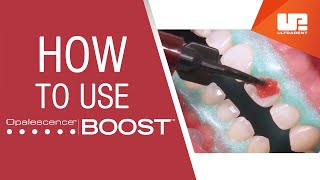 How to Use Opalescence™ Boost™ Professional Teeth Whitening  StepbyStep Procedure [upl. by Culley]