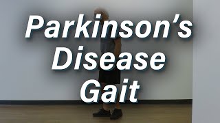 Parkinsons Disease Gait  Moderate Severity [upl. by Erasmus]