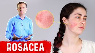 What Can Be Done for Rosacea [upl. by Noremmac]