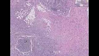 Histopathology GutActinomycosis diverticulitis abscess [upl. by Lockwood700]