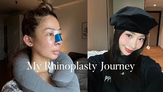 MY RHINOPLASTY JOURNEY 👃🏼✨ [upl. by Neret]