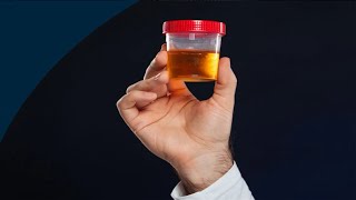 04052024QUELLE EST LA COULEUR DE VOTRE URINE SI VOUS AVEZ DE PROBLEMES DE FOIE [upl. by Lundberg]