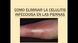 COMO ELIMINAR LA CELULITIS INFECCIOSA EN PIERNAS 🐩 REMEDIOS caseros para la celulitis infecciosa [upl. by Acinok]