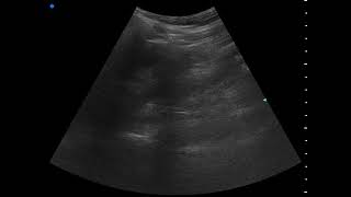 Ruột non tăng nhu động  Hyperperistalsis of the bowel [upl. by Nahij]