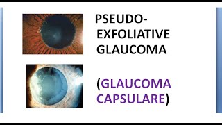 Ophthalmology Pseudo Exfoliative Glaucoma CAPSULARE PEX PEXG Target sign moth eaten Pilocarpine [upl. by Mercuri31]