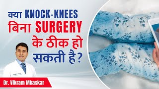 🟢 क्या KnockKnees बिना Surgery के ठीक हो सकती है  How to Fix KnockKnee Without Surgery [upl. by Annaj]