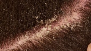 Dandruff Scratching ASMR Scalp Covered in Thick Flakes Dandruff Removal V3 [upl. by Nodal989]