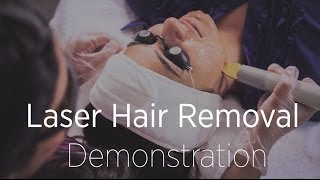 Laser Hair Removal Demonstration  What To Expect During a Treatment [upl. by Kilian270]