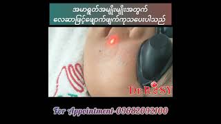 Fractional Laser Treatment အမာရွတ်အမျိုးမျိုးအတွက်လေဆာကုထုံးfractional laserscar fractionallaser [upl. by Newlin]