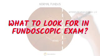 What to look for in fundoscopic exam Neuroaholics [upl. by Claudell775]