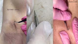 Ingrown Hair Removal  Satisfying Ingrown Hair 19 [upl. by Michell]