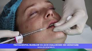 Tratamentul buze cu acid hialuronic de hidratare [upl. by Ika]