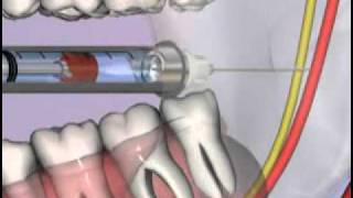 Medical Videos  Malameds Local Anesthesia  05 The Armamentariumaviflv [upl. by Leandro]