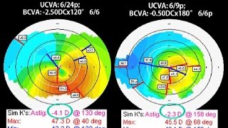 CAIRS A new technique for Keratoconus and corneal ecstasias [upl. by Maram627]