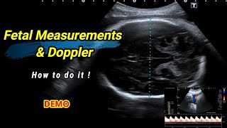 Fetal measurements and Doppler  How to do it [upl. by Malim]