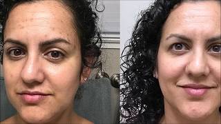 Meladerm Before and After Pictures Amazing Results [upl. by Lancelle]