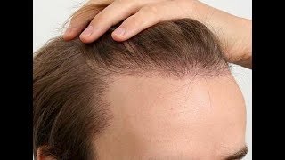 Microneedling amp Hair Loss  Does it work [upl. by Nerual]