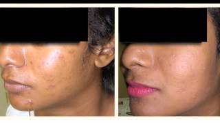 DermaLogics Clinical Acne Results with Melanopeel [upl. by Lamp]