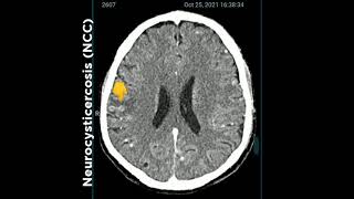 Neuro cysticercosis NCC drarupkarmakar ArupKarmakar reels NeuroCysticercosis [upl. by Acinor]