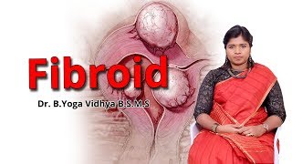 ஃபைப்ராய்டு கட்டிகளுக்கு சிகிச்சை  Fibroid Uterus Treatment  Dr BYoga Vidhya [upl. by Wettam841]