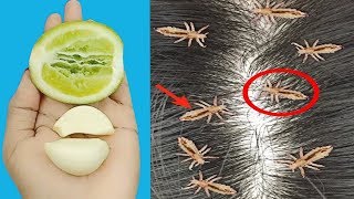 Eliminate LiceAbolish Ways To Eliminate LiceRemove Lice 100 From Your Hair Naturally [upl. by Ikciv666]