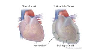 Diseases of the Pericardium [upl. by Llehsad47]