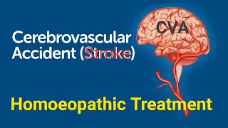 Stroke  Cerebrovascular Accident  CVA  Headache  Homeopathic Treatment  Homeopathic Medicine [upl. by Erusaert]