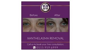 Xanthelasma Removal with Dr Maini [upl. by Iteerp957]