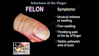 Infections Of The Finger  Everything You Need To Know  Dr Nabil Ebraheim [upl. by Mchenry]